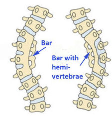 congenitalbars.jpg